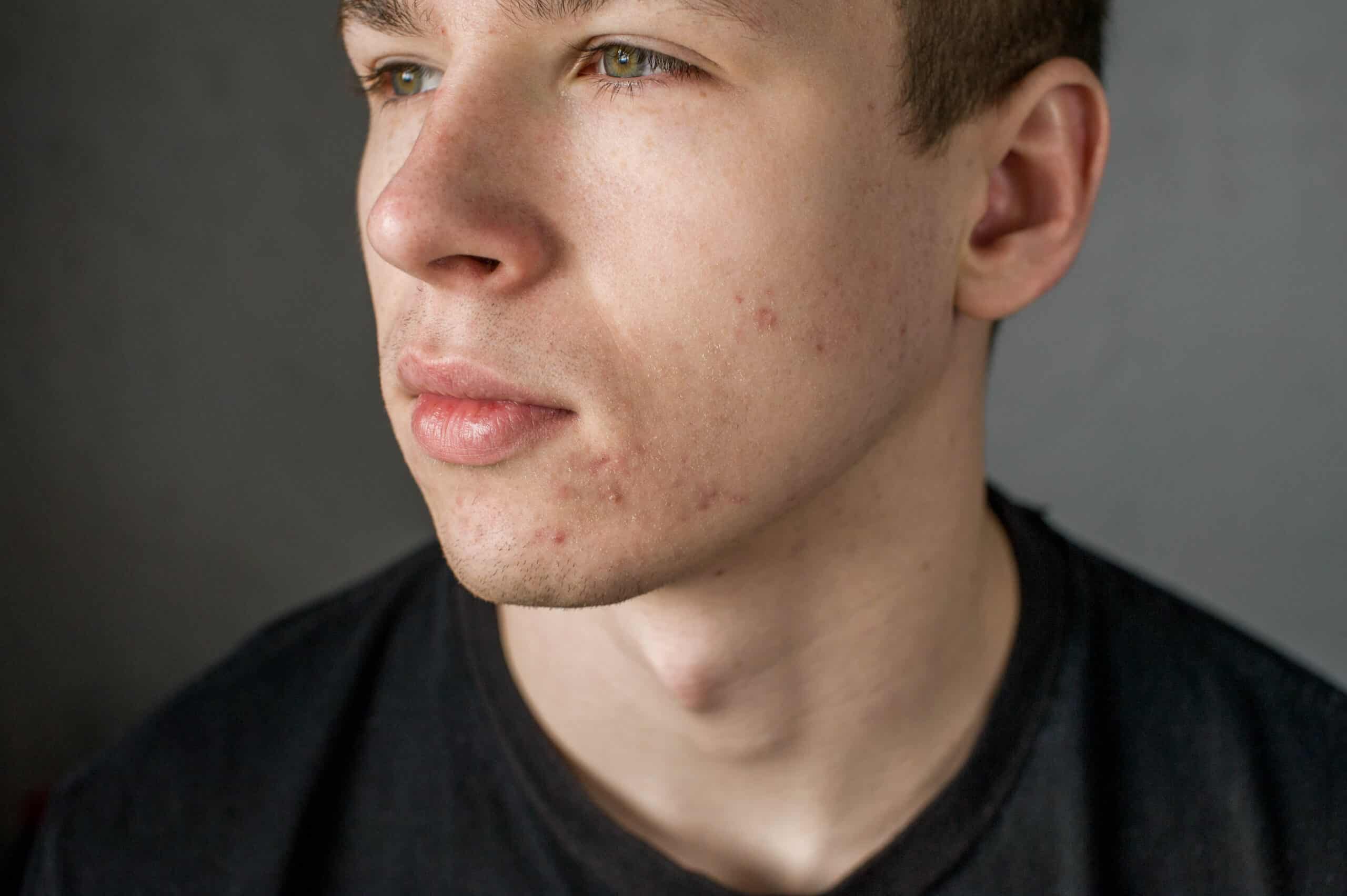 Featured image for “Conquer Chin Acne: Expert Tips for a Clear Complexion!”
